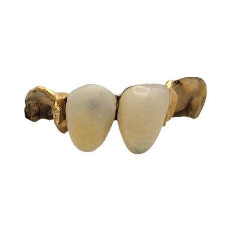 Gold Dental Partial